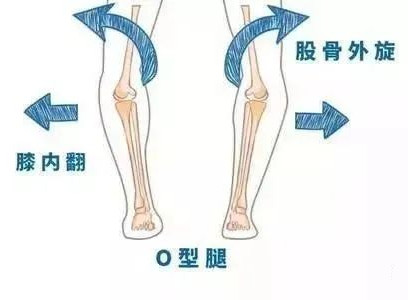 孩子“O”型腿怎么辦？